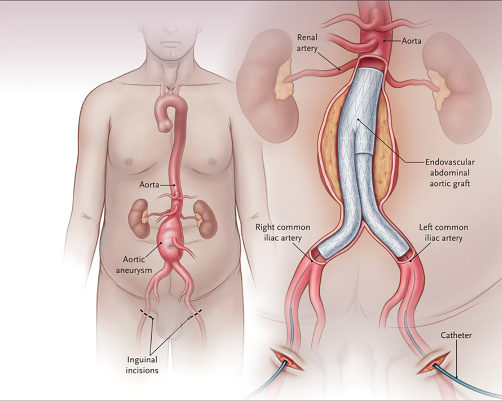 Abdominal Aort Anevrizması